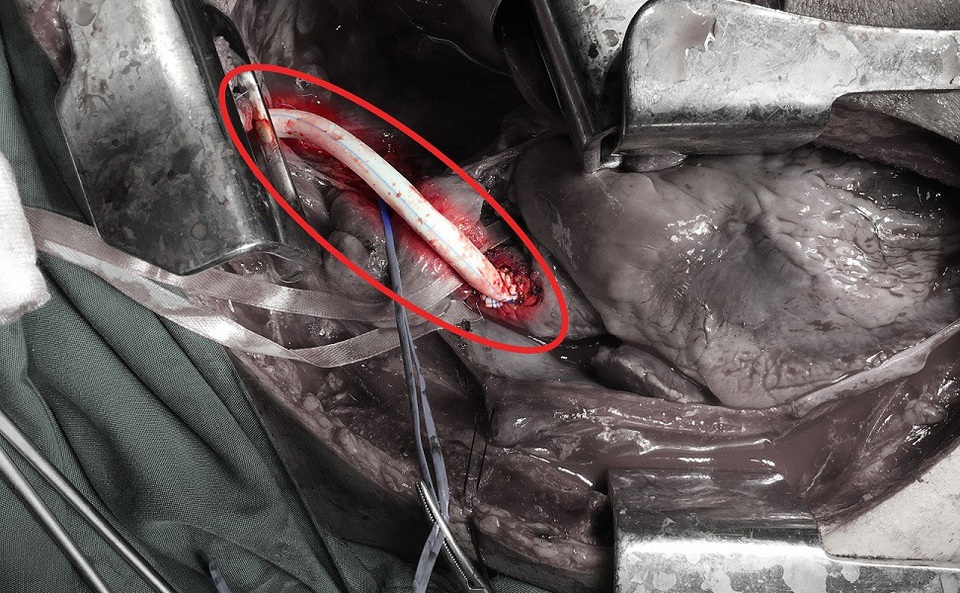 Vị trí động mạch bị đứt được thay thế bằng mạch máu nhân tạo