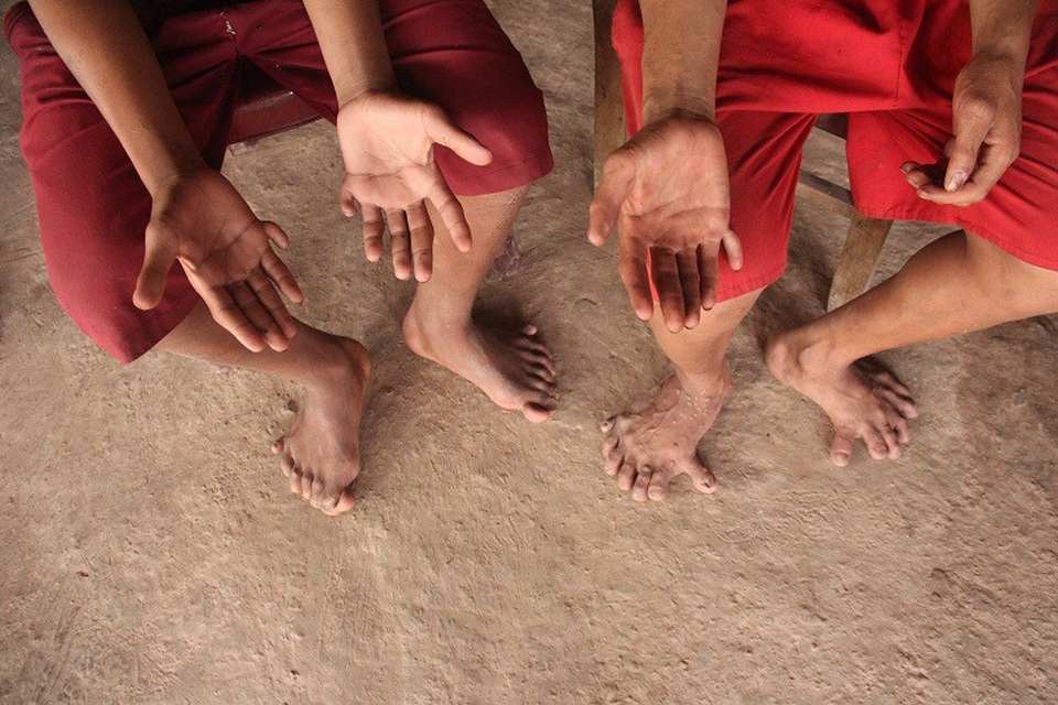 Kỳ lạ gia đình có 14 ngón chân, 12 ngón tay - 2 hai anh em cùng bà ngoại và mẹ đều có 14 ngón chân và 12 ngón tay