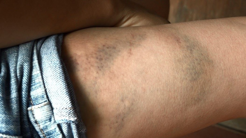 Bé trai 14 tuổi nghi bị bố và mẹ kế đánh bầm tím khắp người - 4 Bé trai 14 tuổi nghi bị bố và mẹ kế đánh bầm tím khắp người - 4