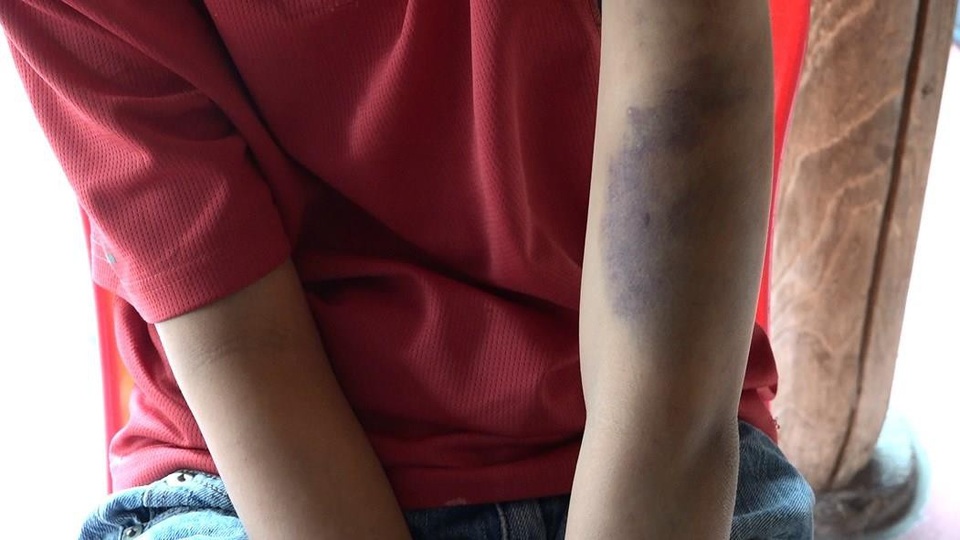 Bé trai 14 tuổi nghi bị bố và mẹ kế đánh bầm tím khắp người - 3 Bé trai 14 tuổi nghi bị bố và mẹ kế đánh bầm tím khắp người - 3