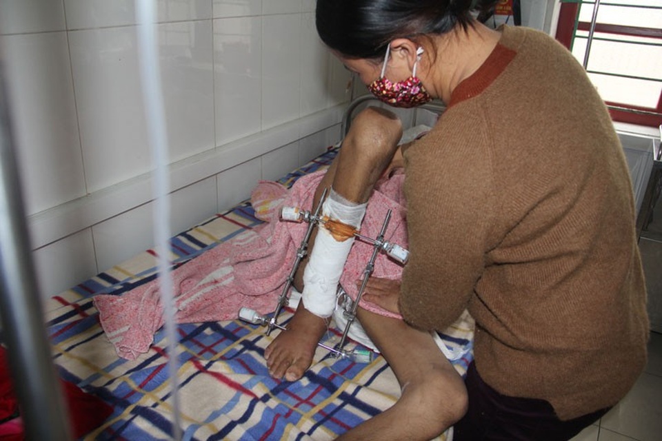 Bị bỏng điện cao thế, chàng trai trẻ mất đôi tay, nguy cơ liệt nửa người - 7 Ăn nằm một chỗ, cùng vết thương còn ra da non khiến Việt vô cùng khó chịu. Mỗi lần như thế người mẹ khốn khổ lại phải khẽ di chuyển chân để con trai dễ chịu hơn.