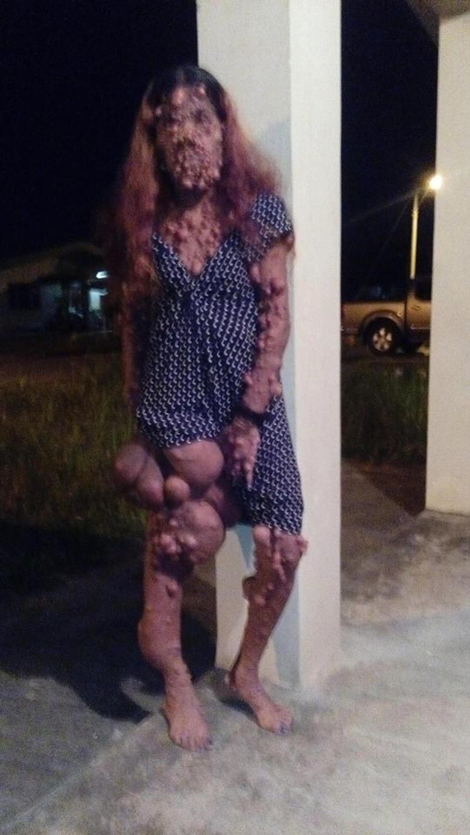 Bệnh lạ khiến người phụ nữ nổi u dày đặc trên bề mặt da toàn cơ thể - 3 Vì mọc các khối u, chân phải của cô bị biến dạng và đau đớn