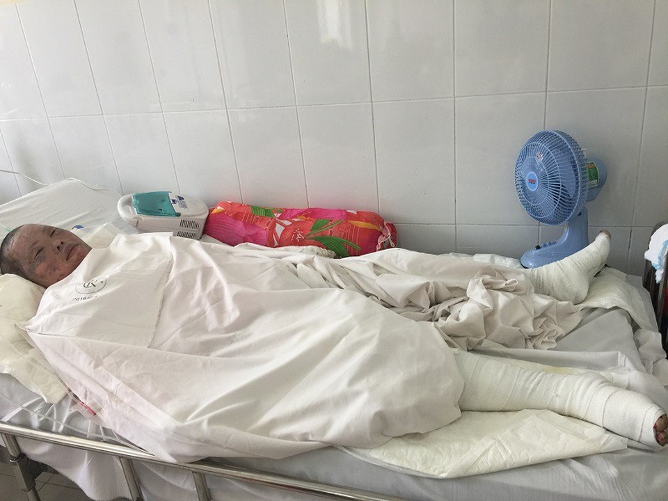 Vụ nổ hầm cầu: Người chồng đang nguy kịch, vợ con bỏng nặng - 1 Chị Hồng Đào bị bỏng 47% cơ thể đang điều trị tại Chợ Rẫy
