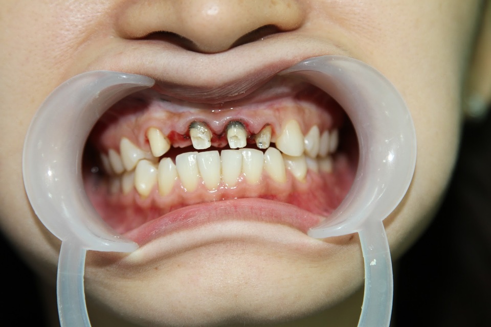 Đừng bọc răng sứ nếu bạn chưa tìm được địa chỉ an toàn - 2 Nguyên nhân lớn khiến răng sứ bị vỡ, bị đen là do phòng khám lắp răng kém chất lượng hoặc răng lắp vào không tương khít với răng thật.