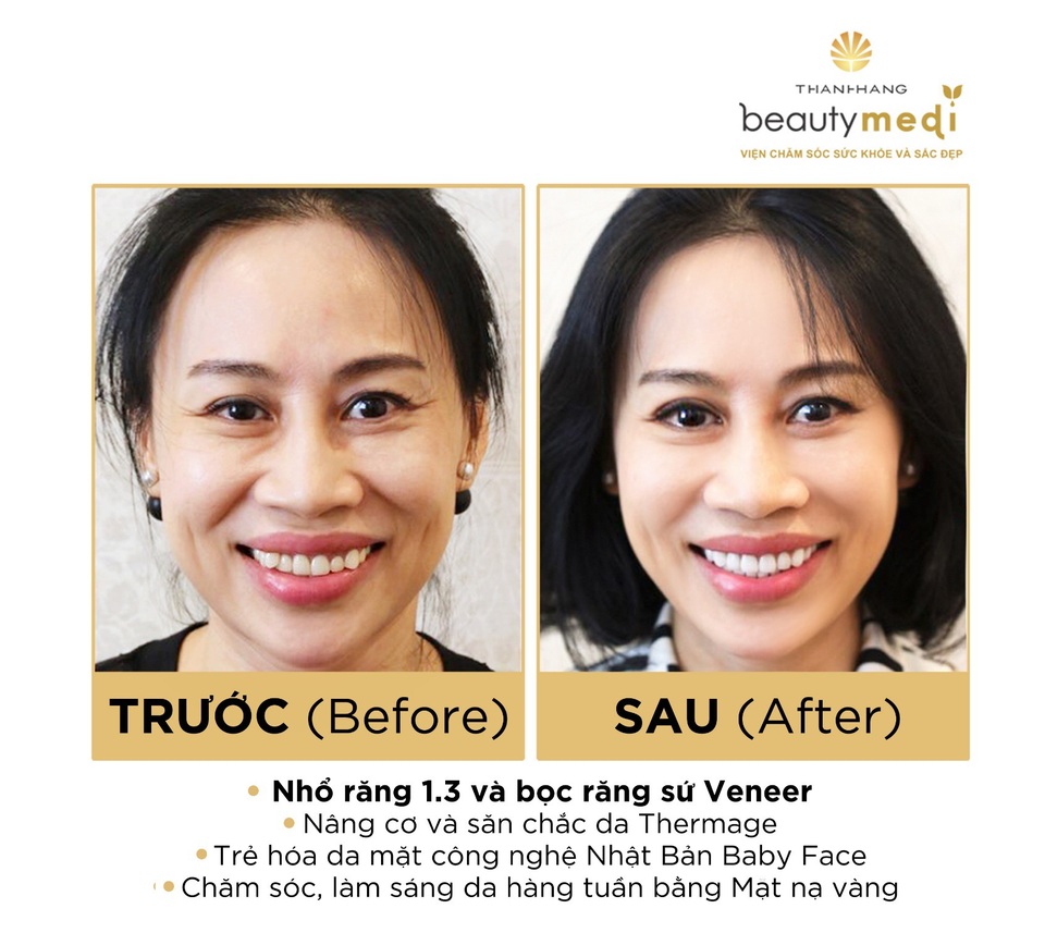 Đừng bọc răng sứ nếu bạn chưa tìm được địa chỉ an toàn - 3 Hình ảnh khách hàng trước và sau khi thực hiện các dịch vụ thẩm mỹ tại Thanh Hằng Beauty Medi