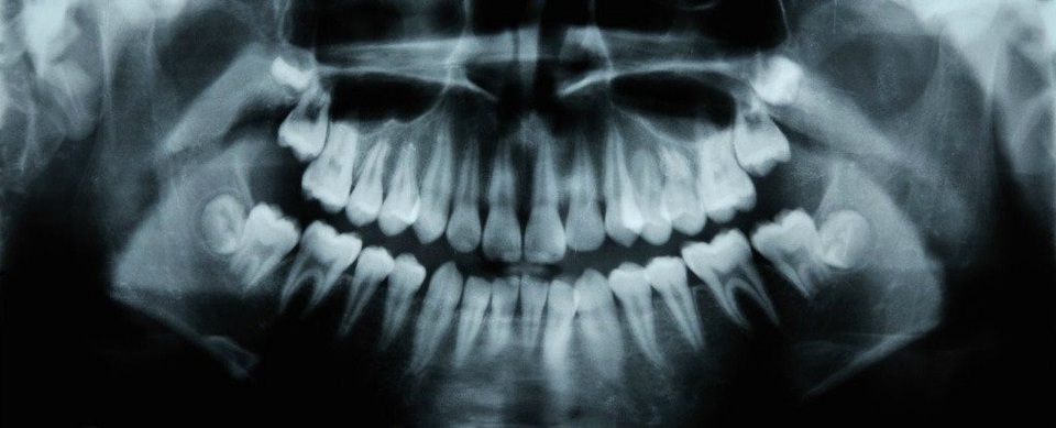 Thuốc điều trị Alzheimer giúp chữa sâu răng - 1