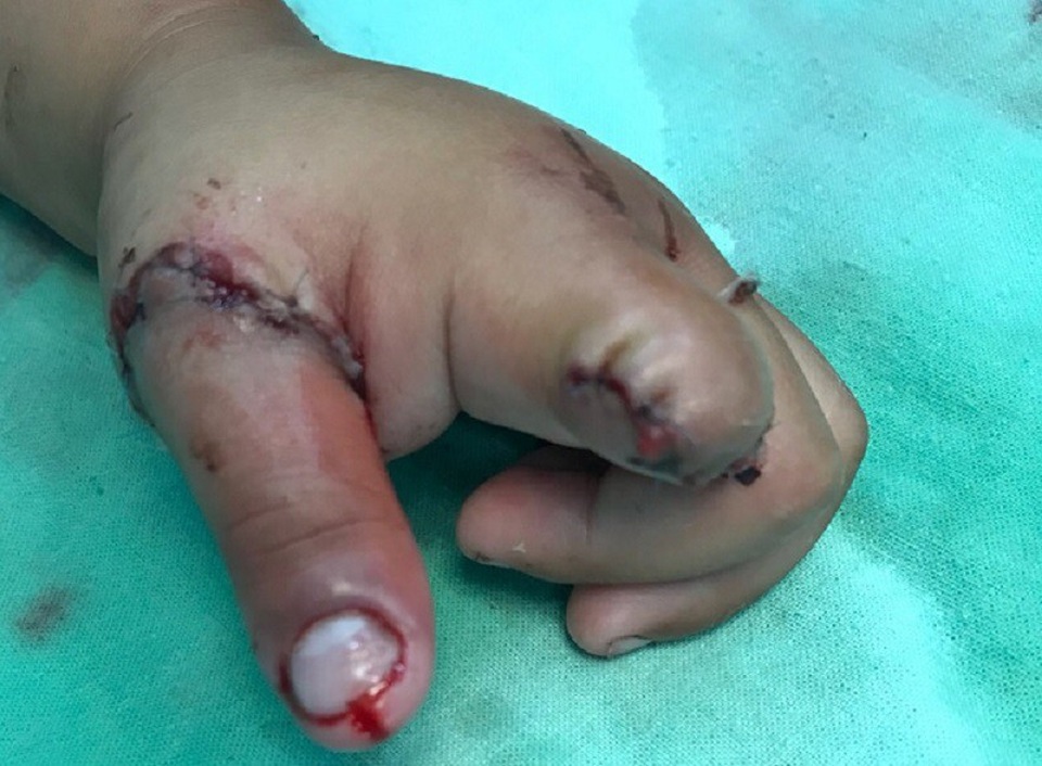 Hi hữu bé 3 tuổi mất ngón trỏ vì thọc tay vào hộp xích xe gắn máy - 1 Dù đã cố gắng cứu chữa nhưng bác sĩ không thể giữ lại ngón trỏ cho bệnh nhi