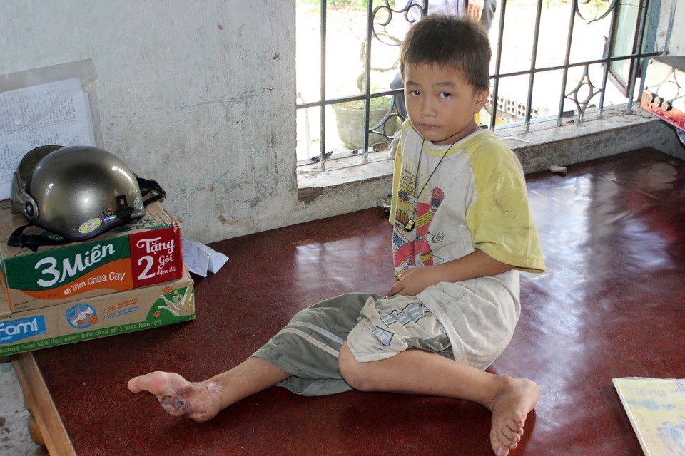 Không tiền phẫu thuật, bé 8 tuổi khổ sở với bàn chân chỉ còn... một ngón - 3 Cháu Đức bị tai nạn nhưng thiếu tiền chữa trị nên giờ bàn chân chỉ còn 1 ngón