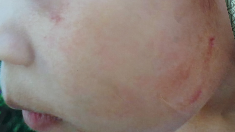 Cô giáo mầm non dùng gậy đánh bé 5 tuổi bầm tím - 3 Mặt và môi của cháu Bảo bị bầm do cô Nga đánh trong nhà vệ sinh