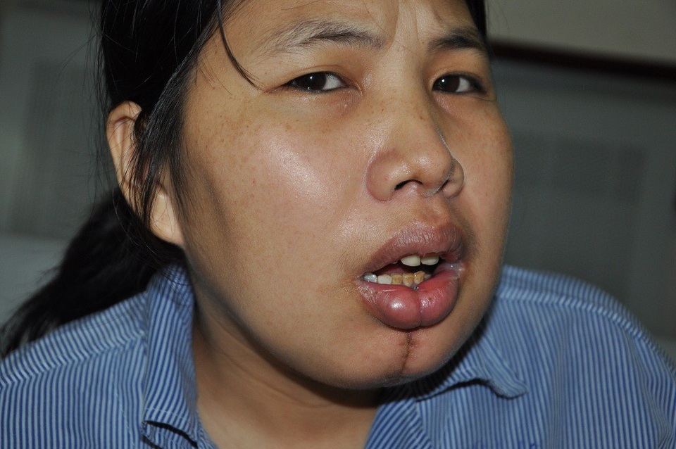 Nghẹn ngào cảnh hai vợ chồng ung thư chăm nhau trong nước mắt - 1 Phát hiện ung thư xương hàm khiến chị Vân phải nhập viện điều trị, trong khi chồng cũng đang truyền hóa chất vì ung thư hạch.