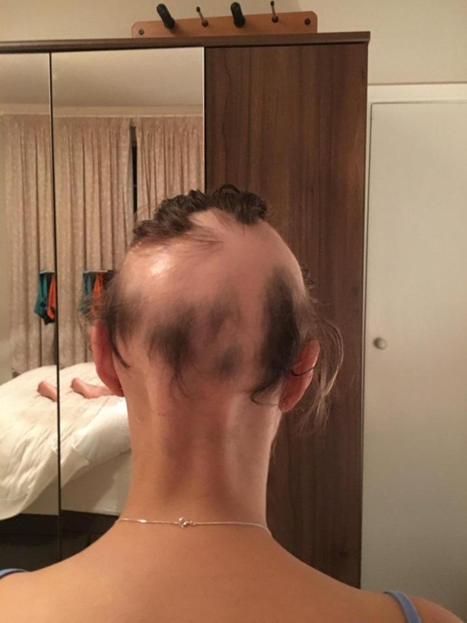 Tiêm hormone không giải quyết vấn đề và tóc rụng quá nhiều khiến Michelle bị trầm cảm