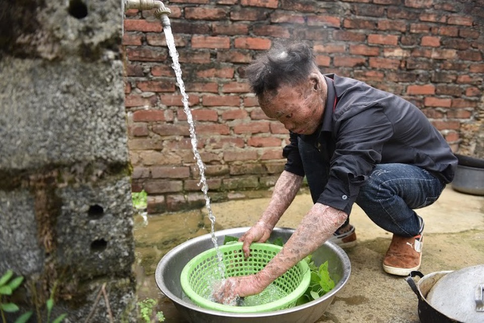 Cuộc sống lạc quan của 9x mắc bệnh "người cá" hiếm gặp ở Hà Nội - 3 
Căn bệnh lạ khiến cho Thọ gặp không ít sự kỳ thị của những người xung quanh. Dù đi học hay đi chơi, Thọ cũng bị mọi người nhìn với ánh mắt dò xét và gọi trêu chọc là Thọ “sước”, Thọ “cá”, người quái vật… khiến cậu vô cùng tủi thân, đau khổ. Thậm chí nhiều người hàng xóm còn đồn thổi Thọ bị ma ám, làm điềm xấu cho cả nhà.