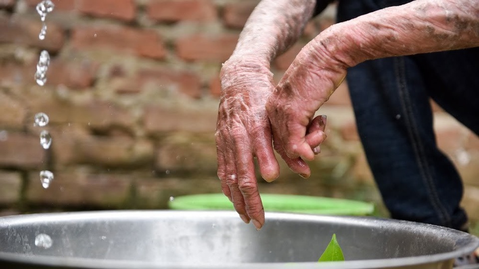 Cuộc sống lạc quan của 9x mắc bệnh "người cá" hiếm gặp ở Hà Nội - 4 Càng lớn, bệnh tình của Thọ càng trở nên nặng hơn, những lớp da liên tục bong tróc thành từng mảng. Do da không có tuyến mồ hôi để tự bài tiết, nên mùa hè, Thọ phải đằm mình trong nước lạnh, 50 – 60 lần mỗi ngày, mùa đông các vết nứt toạc máu, da bỏng rát vô cùng đau đớn, khổ sở.