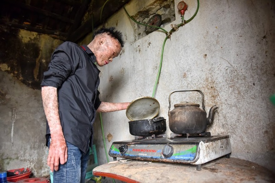 Cuộc sống lạc quan của 9x mắc bệnh "người cá" hiếm gặp ở Hà Nội - 5 Thọ cho hay nhiều đêm thức trắng bởi sự dằn vặt, đau khổ về ngoại hình. Rất nhiều lần cậu phải trốn tránh ánh mắt kỳ thị của mọi người xung quanh. Nhớ lại những ngày tháng trĩu nặng ấy, Thọ nghẹn ngào cho biết: “Nhiều lúc tủi thân quá, em chỉ muốn chết quách cho xong tuy nhiên cứ nghĩ đến bố me, gia đình là em lại có thêm động lực để sống tiếp”.