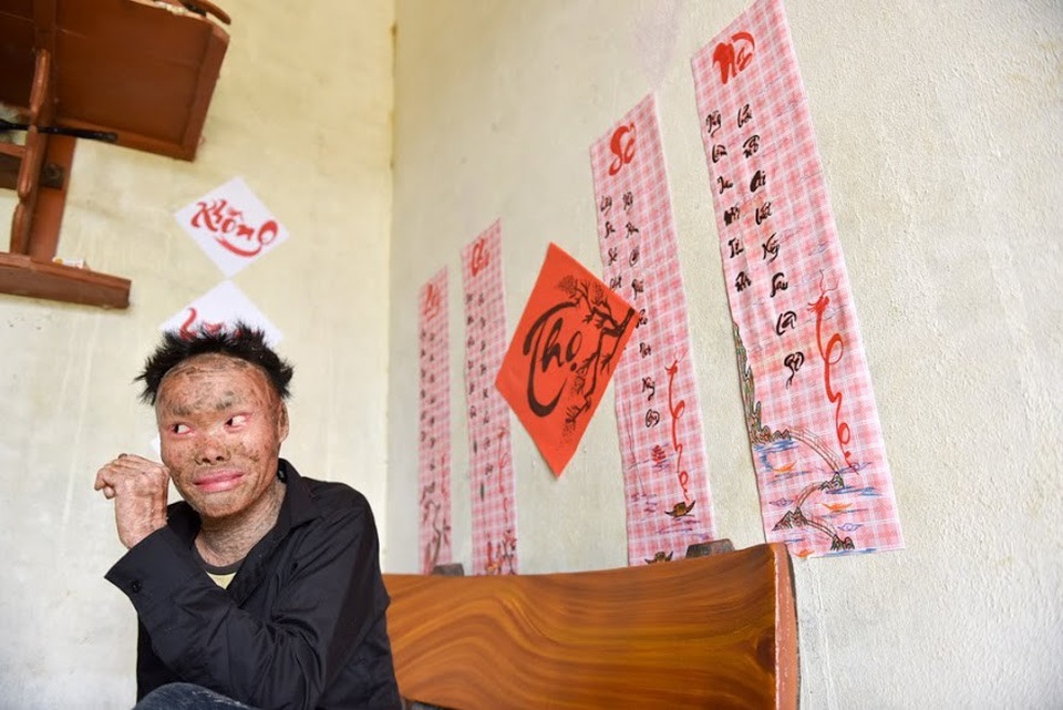 Cuộc sống lạc quan của 9x mắc bệnh "người cá" hiếm gặp ở Hà Nội - 1 Ngay từ khi sinh ra Ngô Văn Thọ (SN 1992, Hữu Văn, Chương Mỹ, Hà Nội) đã mắc phải căn bệnh hoại tử da hay còn gọi là bệnh da cá khiến cho da trở nên khô ráp và sần sùi như vảy cá. Trong suốt những năm sống chung với căn bệnh quái ác, chàng “người cá” gặp không ít khó khăn trong cuộc sống bởi sự kỳ thị của mọi người xung quanh.