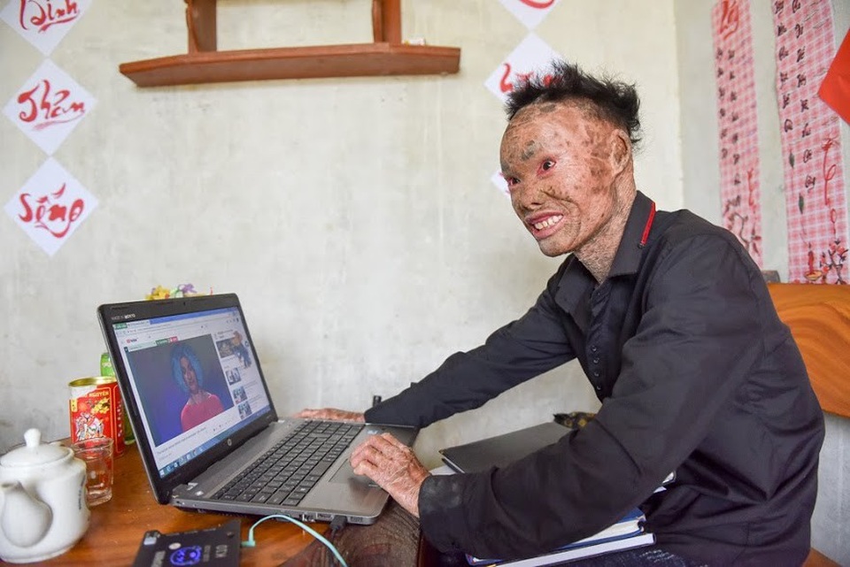 Cuộc sống lạc quan của 9x mắc bệnh "người cá" hiếm gặp ở Hà Nội - 8 Hiện trang cá nhân của Thọ có hơn 8.000 người theo dõi và kết bạn. “Trước đây, em tự ti lắm, không dám soi gương, không dám chụp ảnh hay gặp gỡ mọi người nhưng đọc sách, báo thấy nhiều người còn khổ và vất vả hơn mình mà vẫn thành công trong cuộc sống khiến em có động lực để cố gắng nhiều hơn nữa”, Thọ nói.