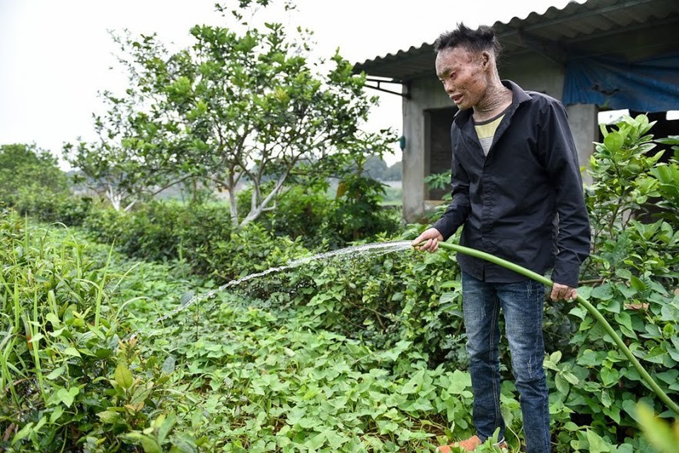 Cuộc sống lạc quan của 9x mắc bệnh "người cá" hiếm gặp ở Hà Nội - 6 Cuộc sống lạc quan của 9x mắc bệnh "người cá" hiếm gặp ở Hà Nội - 6