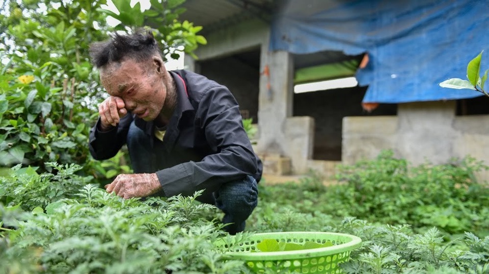 Cuộc sống lạc quan của 9x mắc bệnh "người cá" hiếm gặp ở Hà Nội - 2 Thọ là con út trong một gia đình có 3 anh em, tuy nhiên chỉ riêng mình anh là mắc căn bệnh hiếm gặp này. “Mẹ tôi kể lại, lúc chào đời da tôi hoàn toàn bình thường như những đứa trẻ khác nhưng chỉ sau đó ít lâu bỗng tím tái, rồi bong tróc thành từng lớp như da rắn. Khi mang lên bệnh viện thăm khám, bác sỹ kết luận là bệnh hoại tử da và không có khả năng chữa khỏi”, Thọ kể.