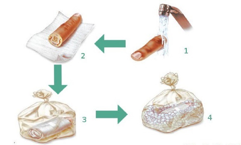 Cách xử trí người bị tai nạn đứt lìa một phần cơ thể - 1 Sơ cứu, bảo quản phần chi nhỏ bị đứt lìa