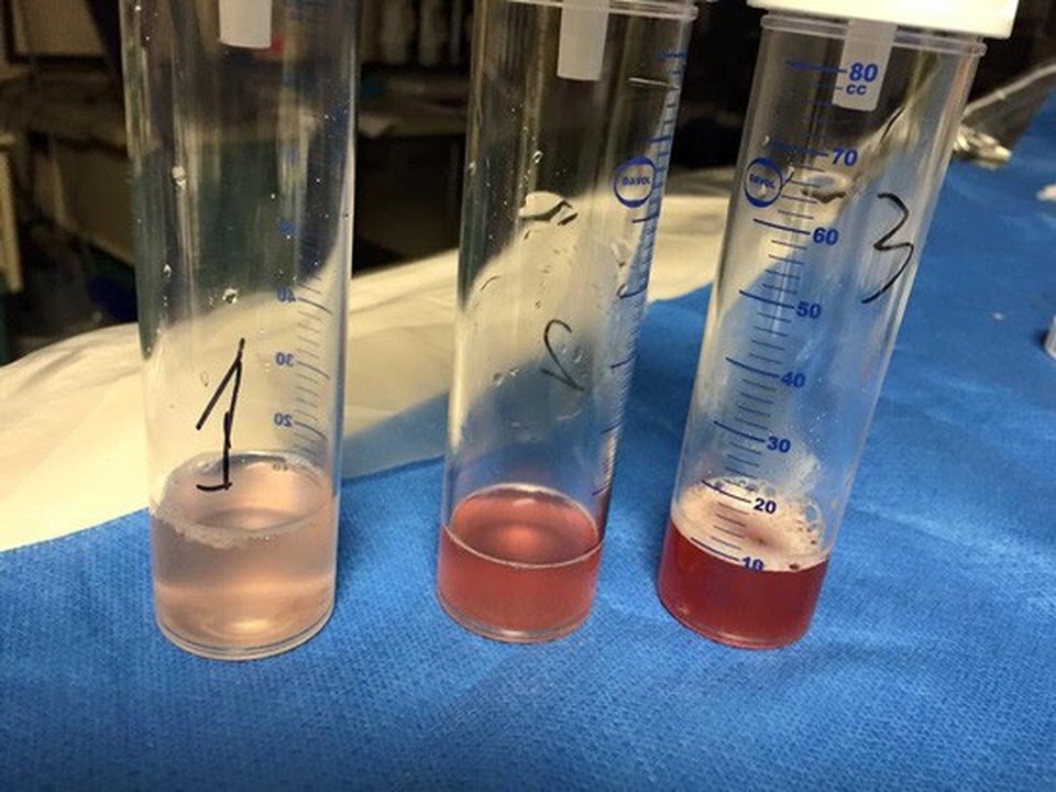 Xét nghiệm chuyên sâu, hội chẩn ra nước ngoài phát hiện bệnh hiếm gặp