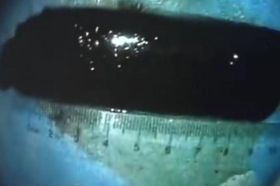 20 năm sống với cái bật lửa… trong bụng - 1