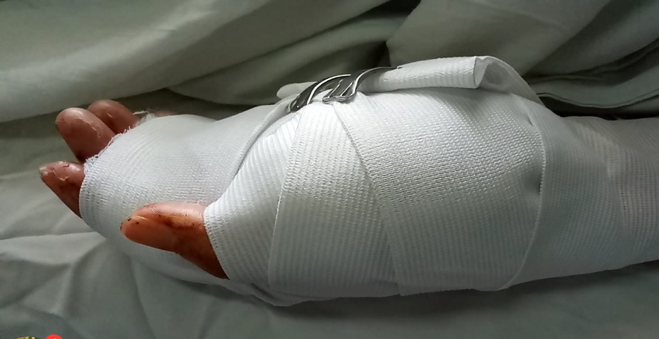 Cô gái bị chém thương nặng khi đang chơi game - 1 Chị H. bị chém thương nặng ở tay và đã được các bác sĩ phẫu thuật xử lý