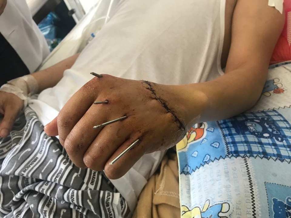 7 tiếng nối bàn tay bị đứt lìa cho bệnh nhân đã hôn mê - 1 Bàn tay đứt lìa của bệnh nhân M. đã được các bác sĩ Bệnh viện Đà Nẵng nối thành công