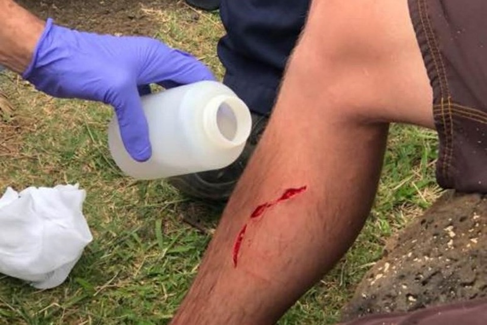 Người xui nhất quả đất: Bị rắn, gấu rồi cá mập tấn công - 2 Vết thương của McWilliams khi bị cá mập cắn gần đây. Ảnh: Facebook