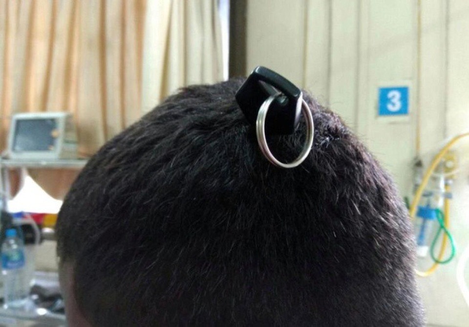 Hy hữu: Bị chìa khóa cắm thẳng vào đầu - não không tổn thương, chìa vẫn hoạt động tốt! - 1 Chàng trai nhập viện trong tình trạng vô cùng đáng sợ