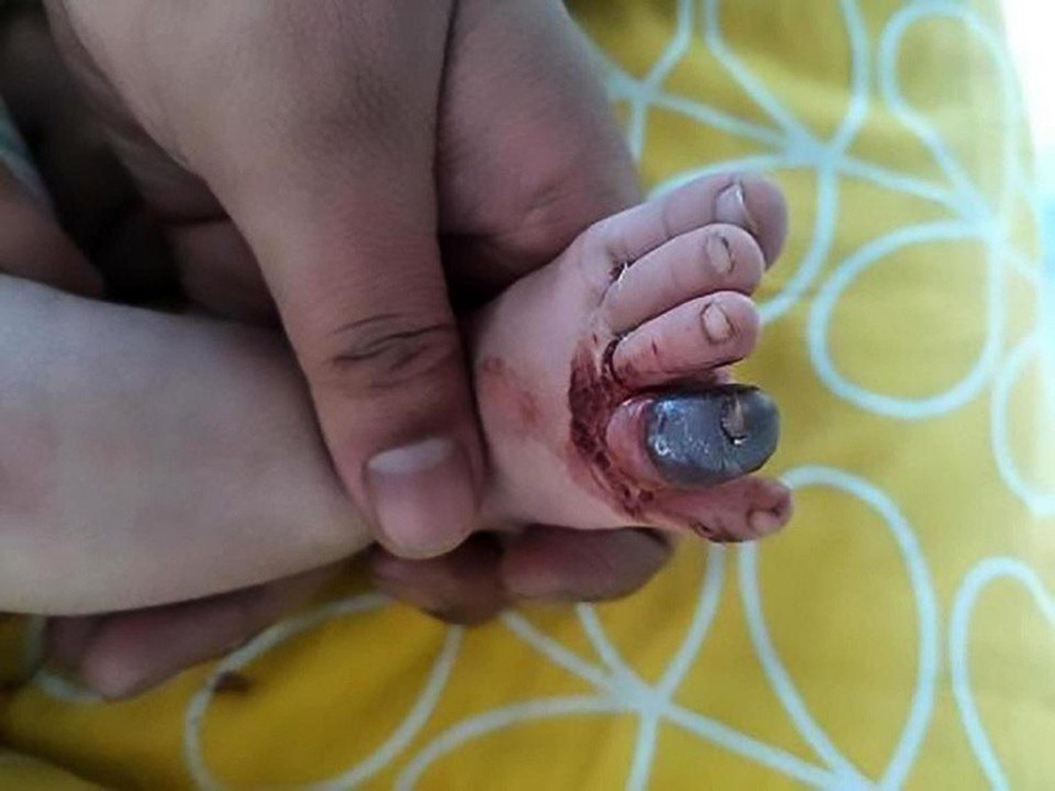 Trước đó, một cậu bé người Trung Quốc đã phải cắt bỏ ngón chân vì bị tóc vướng vào