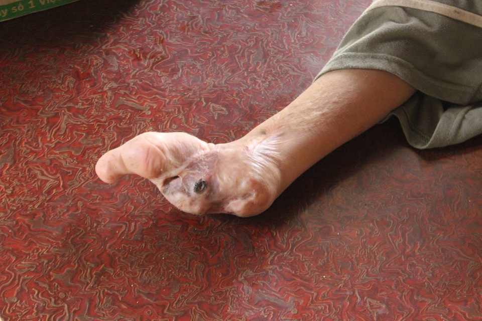 Không tiền phẫu thuật, bé 8 tuổi khổ sở với bàn chân chỉ còn... một ngón - 4 Không tiền phẫu thuật, bé 8 tuổi khổ sở với bàn chân chỉ còn... một ngón - 4