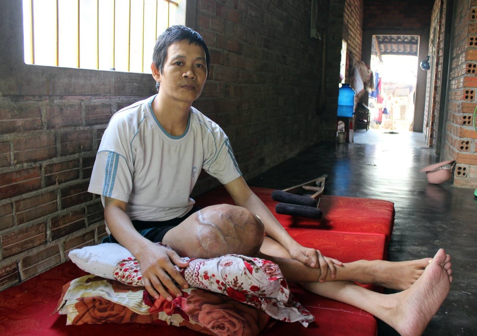 "Hàng ngày, tôi phải dùng đỉa hút máu chính mình cho... đỡ đau !" - 2
Anh Quy mang khối U bên mình đã 7 năm nhưng không có tiền chữa trị