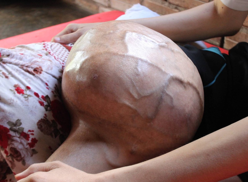 "Hàng ngày, tôi phải dùng đỉa hút máu chính mình cho... đỡ đau !" - 3 Nay khối u đã quá to, nếu không giải phẫu thì anh có thể mất mạng