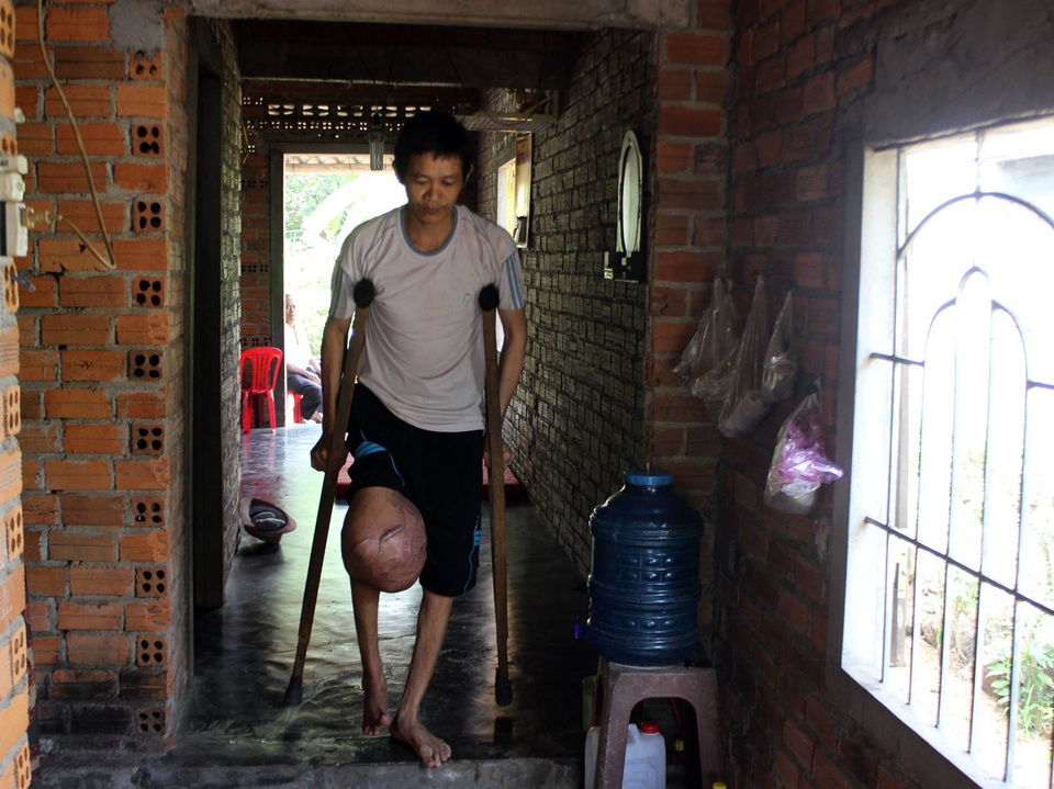 "Hàng ngày, tôi phải dùng đỉa hút máu chính mình cho... đỡ đau !" - 4 Khối U quá to nên việc đi lại anh phải dùng nạng chống