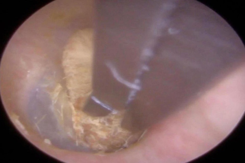 Đoạn video quay cảnh bác sĩ gắp cục bông khiến nhiều người ớn lạnh