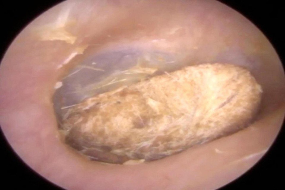 Bệnh nhân đã có thể bị điếc nếu cục bông chui vào sâu hơn