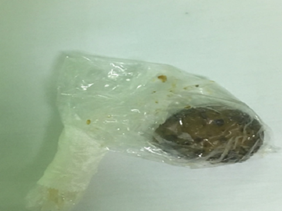 Đau bụng dữ dội vì nguyên cây nấm đông cô trong ruột - 1 Cây nấm khoảng 5cm là nguyên nhân khiến người bệnh bị tắc ruột