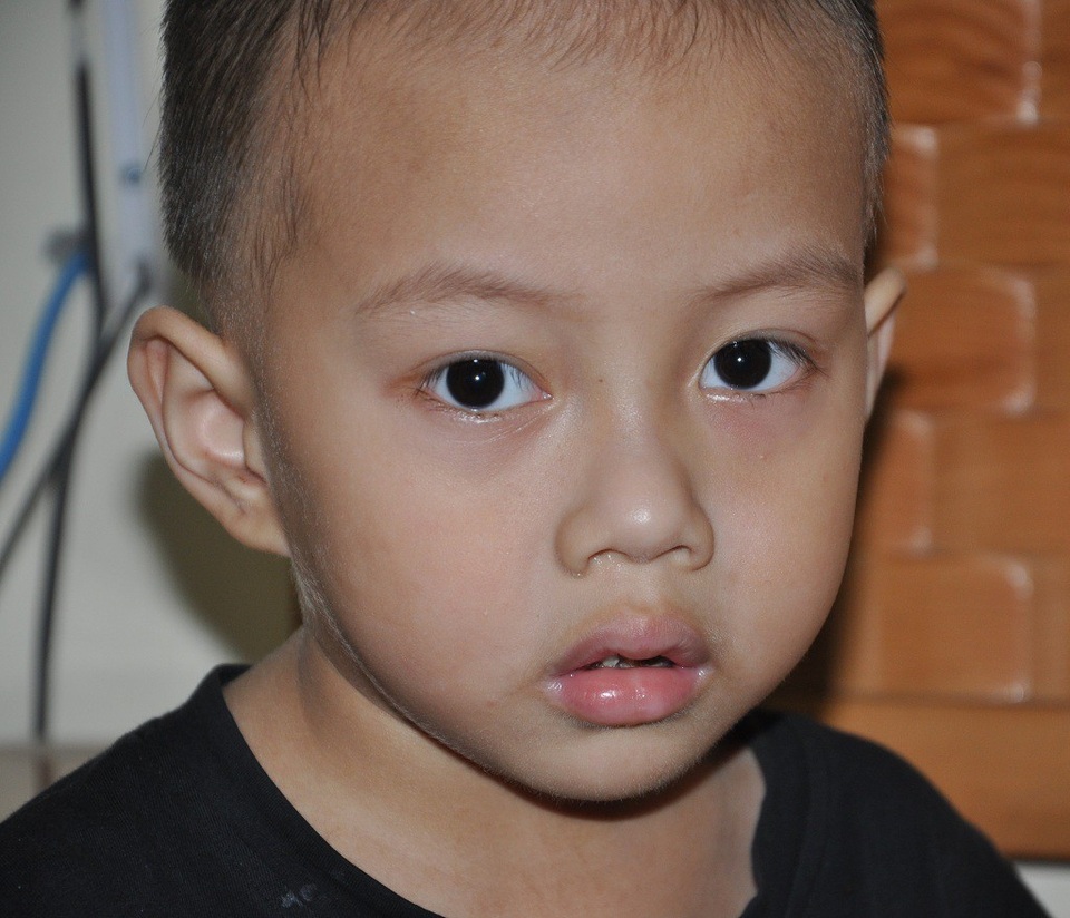 Gần 160 triệu đồng đến với bé Thắng mồ côi bị u khớp gối - 1 Bố chết, mẹ bỏ đi nên Thắng chỉ biết dựa vào bà nội.