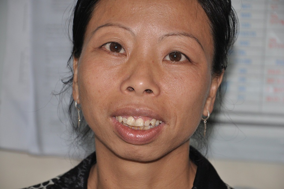 Hơn 134 triệu đồng đến với vợ chồng chị Dèn - 1 Tâm lý chị Dèn đã tốt lên rất nhiều khi nhận được sự ủng hộ của bạn đọc Dân trí.