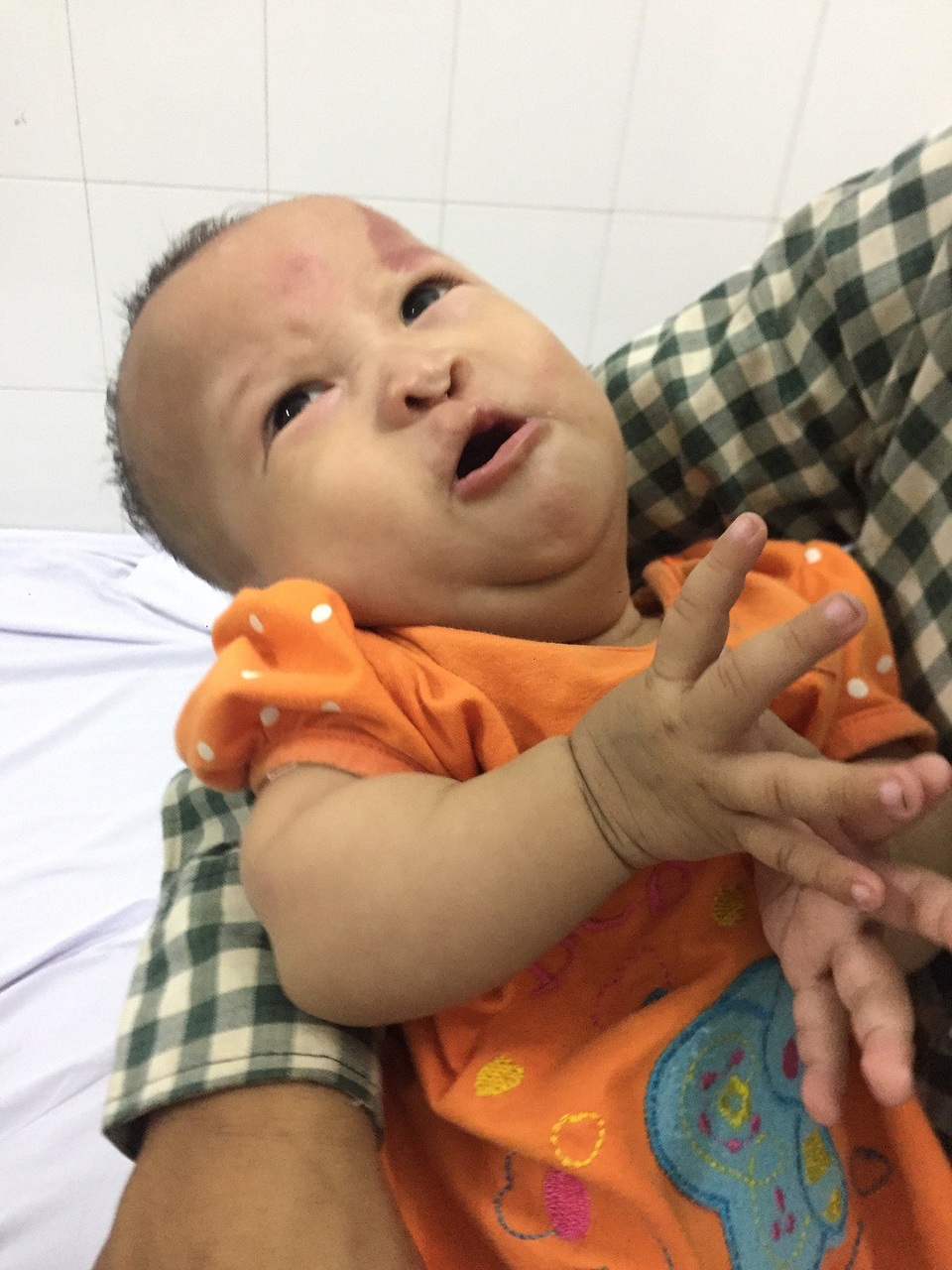 Hơn 141 triệu đồng đến với bé Yến Chi 7 tháng tuổi bị đa dị tật - 1 Sinh ra Yến Chi đã bị tim bẩm sinh và dị tật môi nên phải phẫu thuật nhiều lần.
