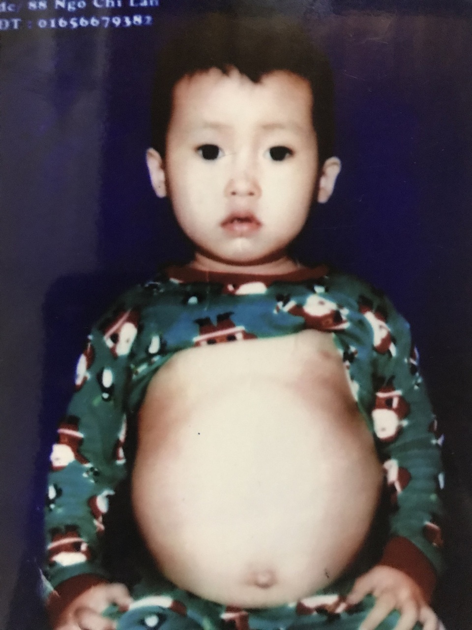 Chồng ngược đãi, vợ một mình gồng gánh chữa bệnh cho 3 con bệnh tật, tai nạn - 2 Người con trai út của dì Quy, em Mai Xuân Tiến, sinh năm 2013 cũng mắc căn bệnh to gan, to thận, to lách quái ác hiện đang điều trị tại Bệnh viện Nhi Đồng II, TP Hồ Chí Minh