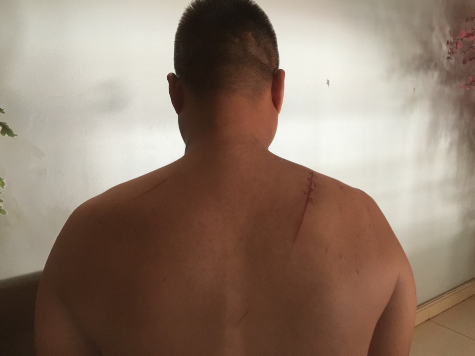 Anh Lê Văn Chính bị đối tượng Trần Quang Tiến chém giữa ban ngày gây thương tích