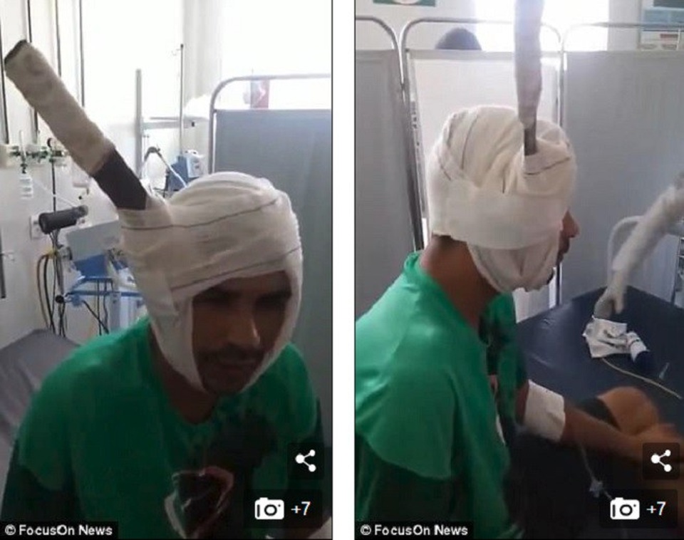 Video: Bị dao đâm xuyên đầu, tù nhân Brazil vẫn tỉnh táo như thường - 2 Ferreira nhập viên trong tình trạng tỉnh táo.