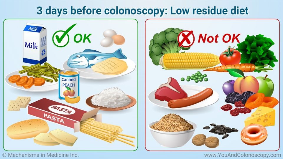 Bỏ túi 4 bước chuẩn bị trước khi nội soi đại tràng phát hiện sớm ung thư - 2 Bỏ túi 4 bước chuẩn bị trước khi nội soi đại tràng phát hiện sớm ung thư - 2