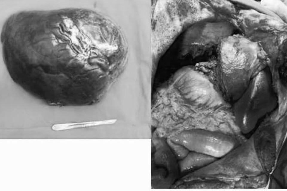 Cắt khối u 5kg “ngụ” trong gan bệnh nhân - 1