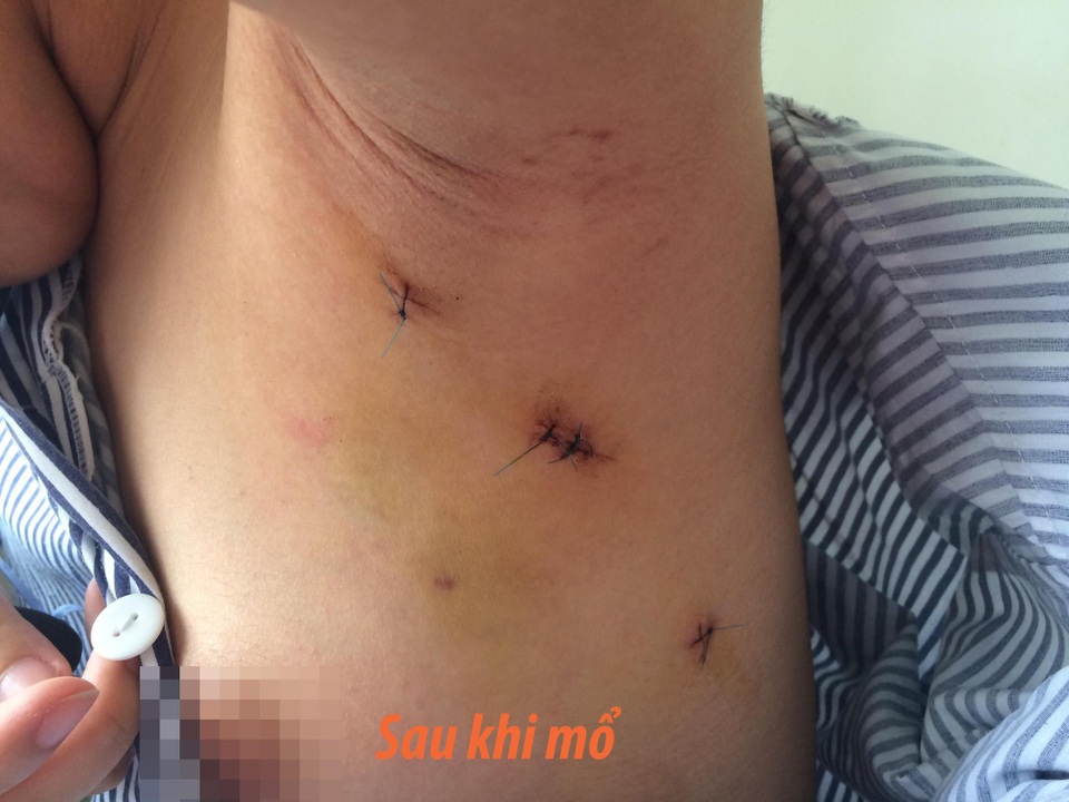 Mổ u xơ tuyến vú không để lại sẹo - 1 Các bác sĩ mổ u x ơ tuyến vú từ đường nách, sẽ không để lại sẹo sau phẫu thuật.