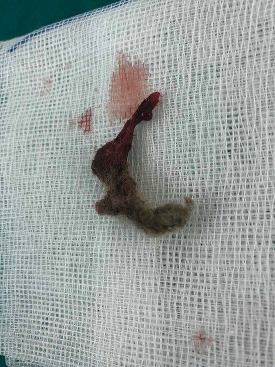 Miếng bông gòn được lấy ra từ âm đạo bệnh nhi 6 tuổi