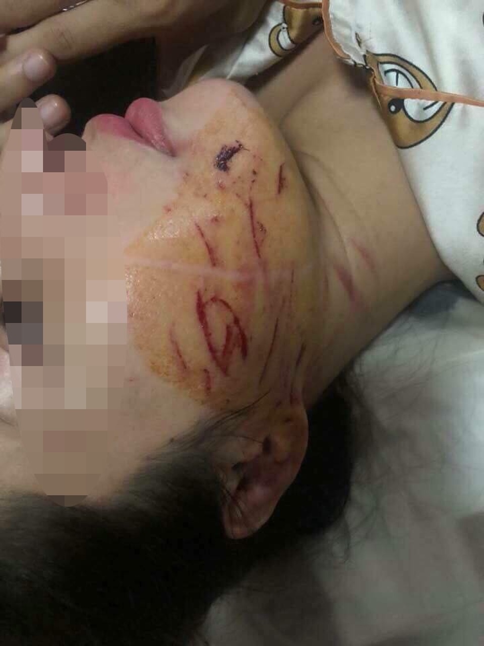 Vụ cô gái bị lột đồ, đổ nước mắm lên người: Triệu tập 2 đối tượng - 2
Nạn nhân đang điều trị tại Bệnh viện Đa khoa tỉnh với nhiều vết thương.