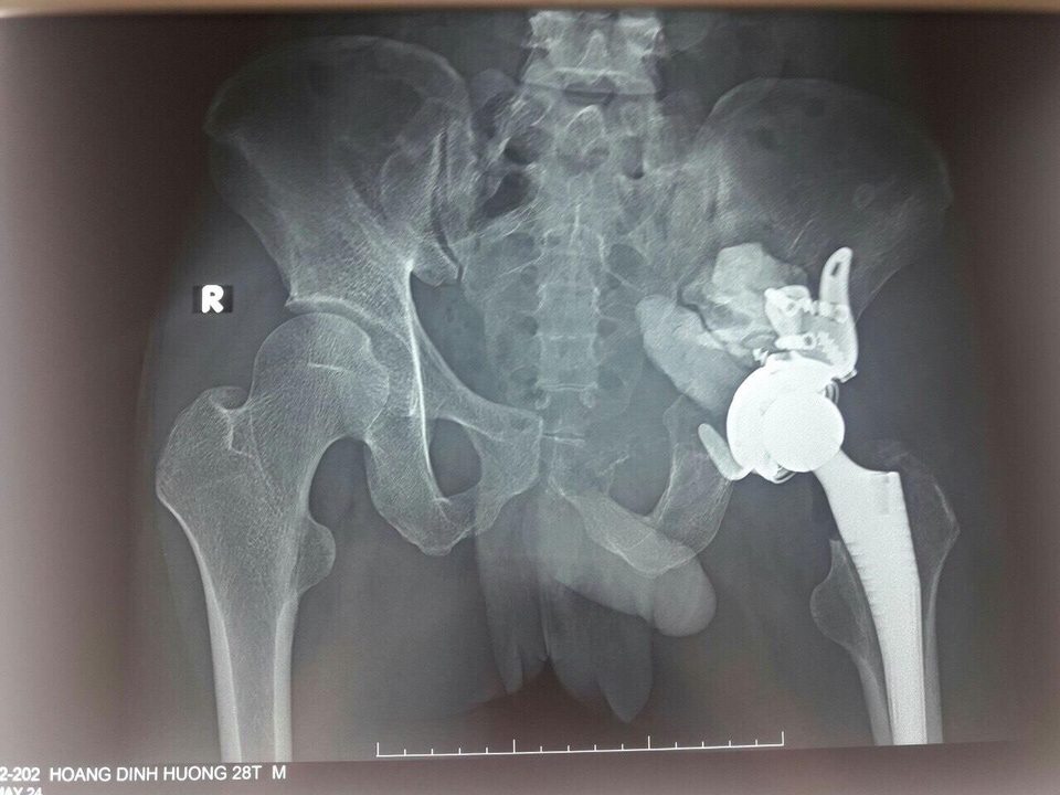 Hình ảnh khối u trong ổ khớp háng bệnh nhân.