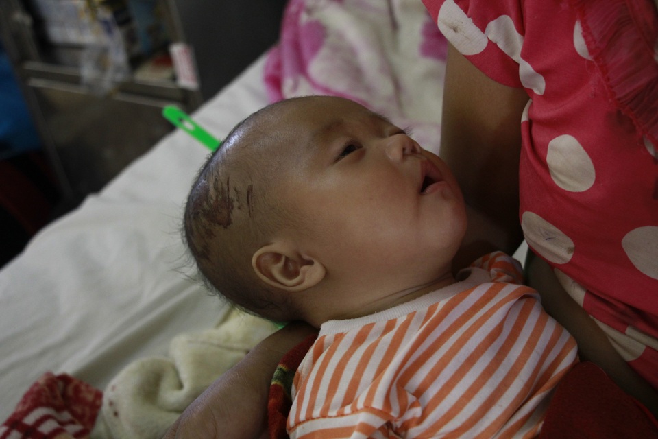 Thương hai anh em người H’Mông nghèo bị chấn thương sọ não - 3 Bé Tiền mới 3 tháng tuổi cũng bị chấn thương vùng đầu